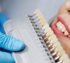 Pakalbėkime apie dantų balinimą: kokios priemonės yra pačios efektyviausios?