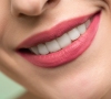 Kuo naudingos dantų laminatės?